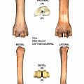 Metacarpo izquierdo