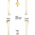 Tibia droit