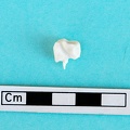 Malleolar bone: medial view