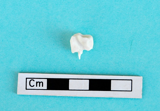 Malleolar bone: medial view