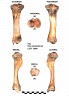 Tibia gauche