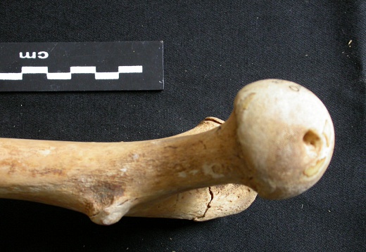 Femur: proximale part