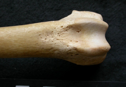 Femur: distal part