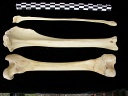 Fémur, tibia et fibula