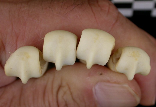 Metacarpals: distal part