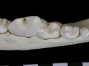 Dentition inférieure