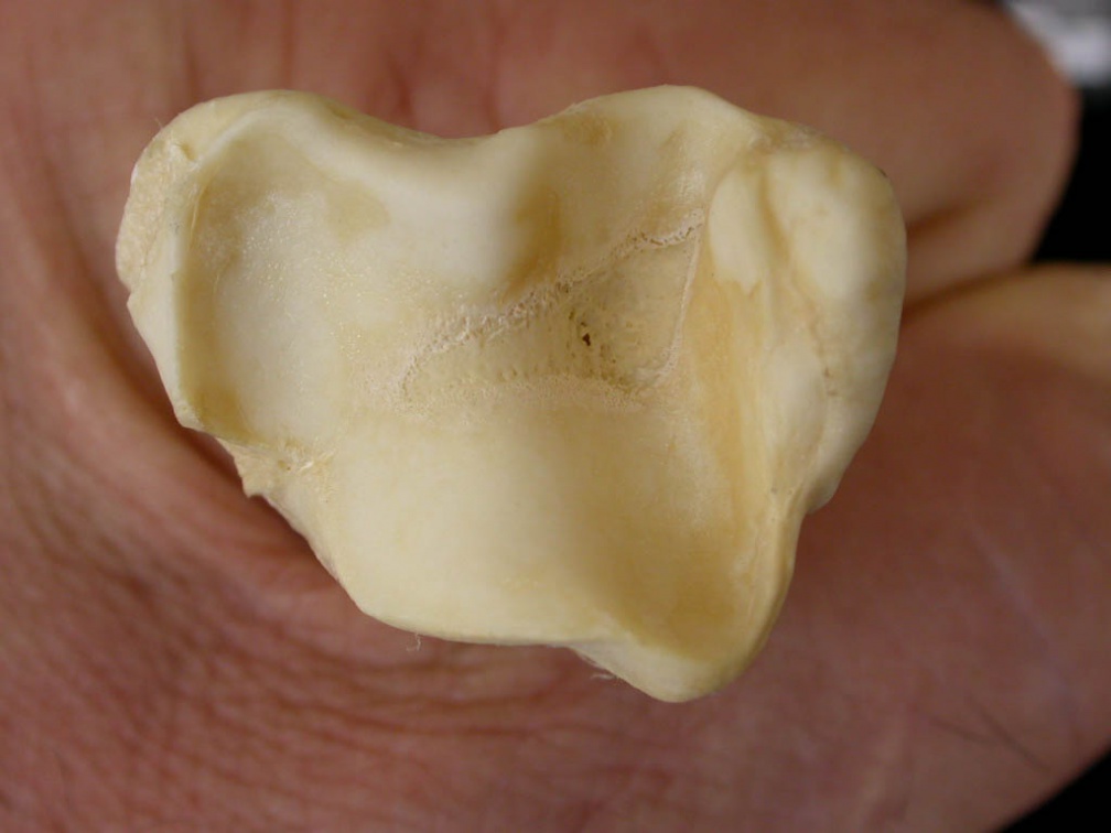 Tibia : partie distale