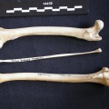 Fémur, tibia et fibula