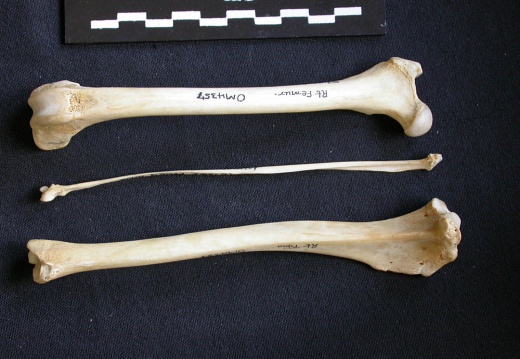 Fémur, tibia et fibula