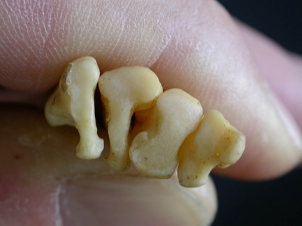 Metatarsianos : parte proximal