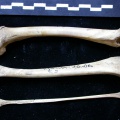Fémur, tibia et fibula