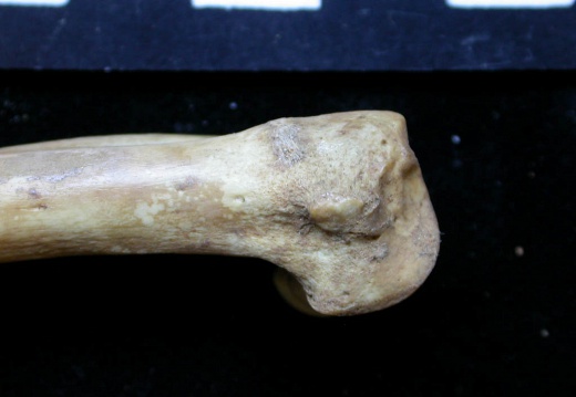 Humerus: distal part