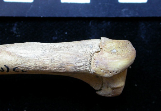 Humerus: proximale part