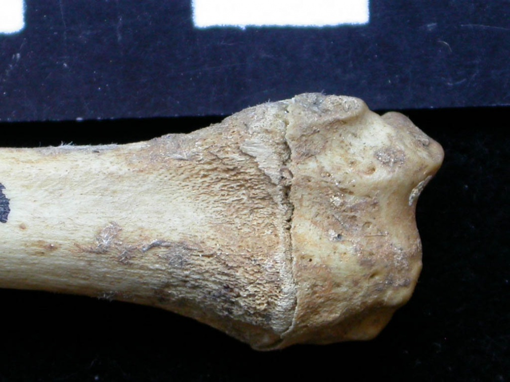 Radius : partie distale