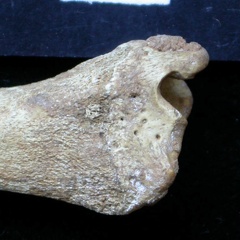  Tibia: distal part