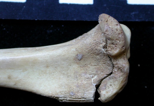  Tibia: proximale part