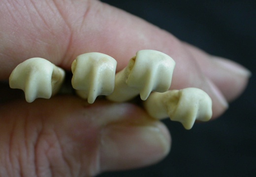 Metacarpals: distal part