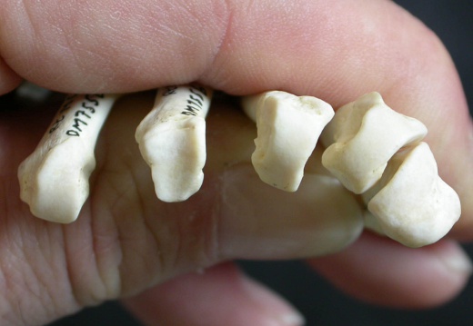 Metacarpals: proximale part