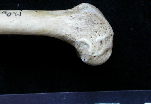 Femur: distal part