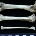 Fémur, tibia et fibula