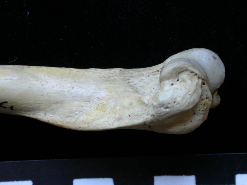 Húmero : parte distal