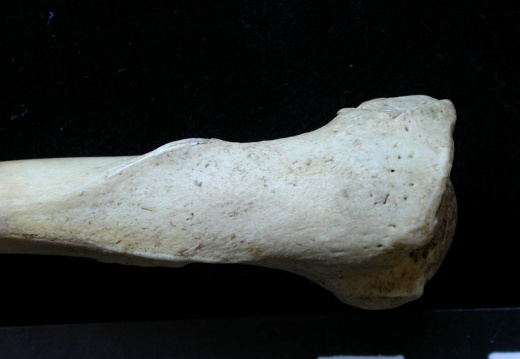 Humerus: proximale part