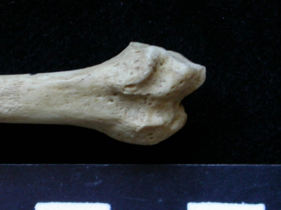 Radius : partie distale