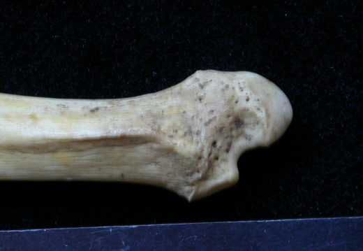  Ulna: distal part