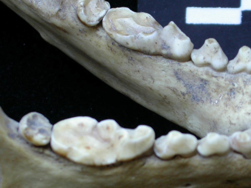 Dentition inférieure