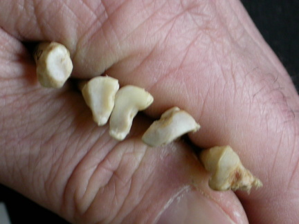 Metatarsianos : parte proximal