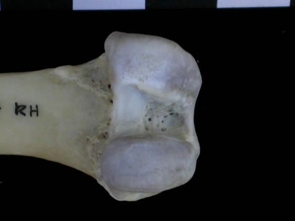 Fémur : parte distal