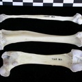 Fémur, tibia et fibula