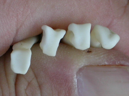 Metacarpianos : parte proximal