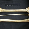 Fémur, tibia et fibula