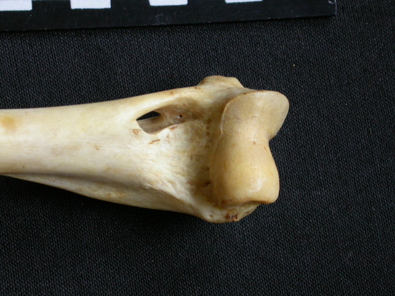 Humerus: distal part