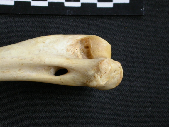 Humerus: distal part
