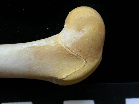 Fémur : parte distal