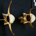 Lumbar vertebrae