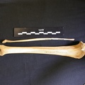 Tibia y fíbula