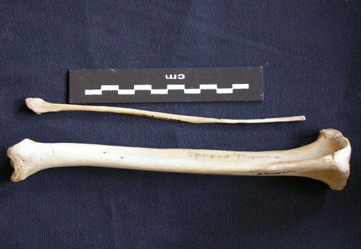 Tibia y fíbula