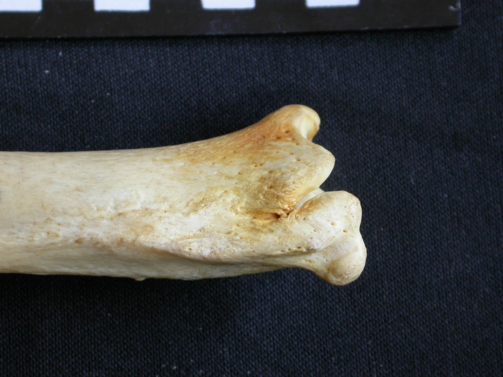 Tibia and fibula: distal part