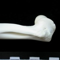 Humerus: distal part