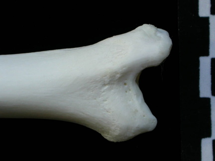 Tibia : parte distal