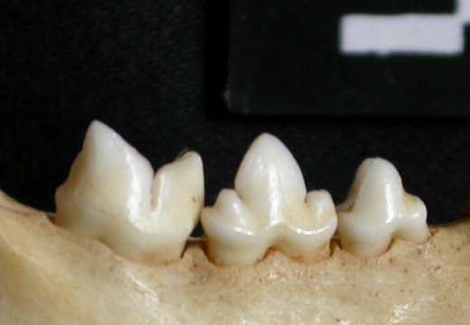 Lower teeth