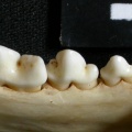Dentition inférieure