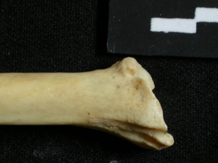 Tibia : parte distal