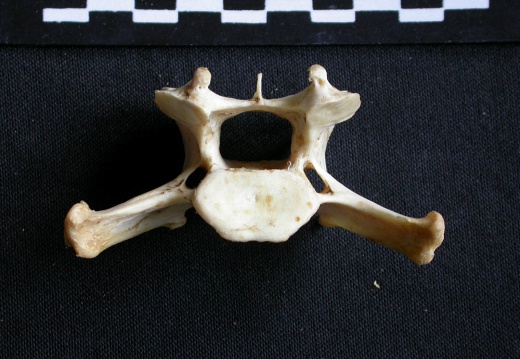 Cervical vertebra