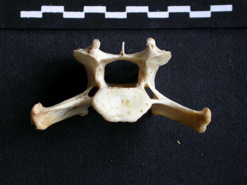 Cervical vertebra