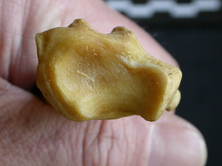 Radius : partie distale