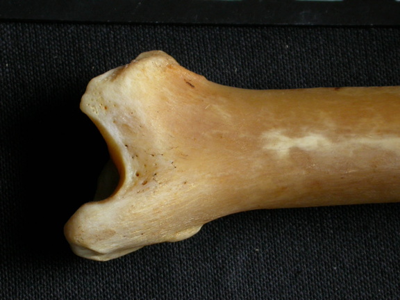  Tibia: distal part
